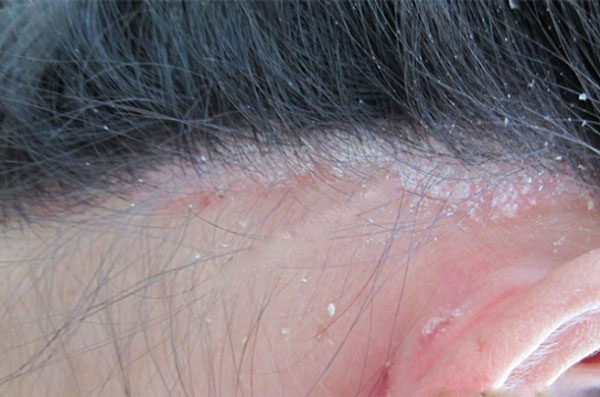 Hình ảnh bệnh vảy nến da đầu